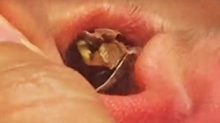Nasty Bug Removed from Ear!  Popping, Removals &amp; Treatment