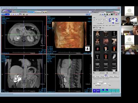Rare extravasation from forniceal rupture (Victoria Chernyak)