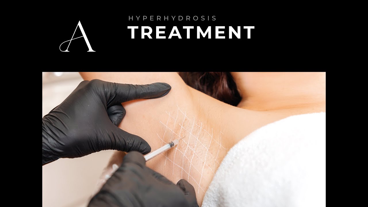 Hyperhydrosis Treatment At Quiet Aesthetics Livingston