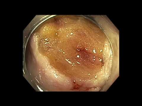 Colonoscopy: IC valve polyp previously partially cut - EMR + Hot Biopsy Avulsion