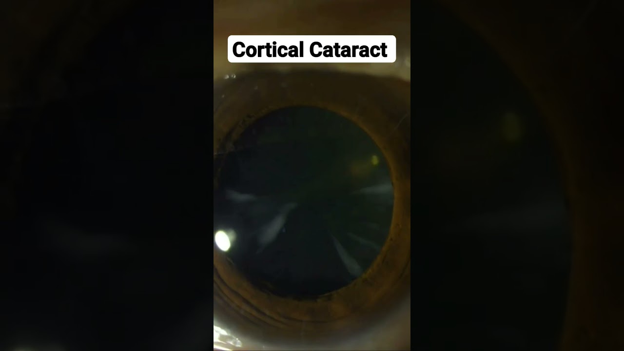 Cortical cataract