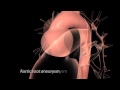 Aortic Disease Aortic Aneurysm And Dissection
