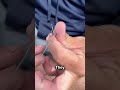 Fishing Hook Got Stuck