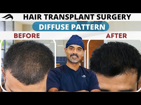 Hair Transplant In Chennai | Best Surgeon Results...