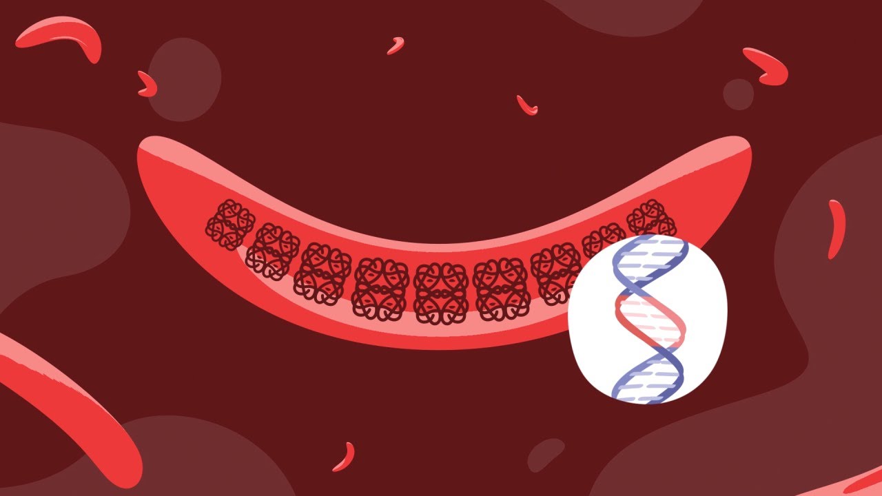 Gene Therapy and Sickle Cell Disease