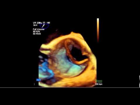 Aortic Dissection 2D vs 3D TEE