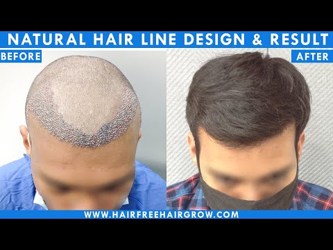 Natural Hair Line Design and Result || Best hair Transplant Clinic in Ahmedabad || HFHG India