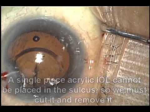 Cataract Surgery Complication - Recovery 