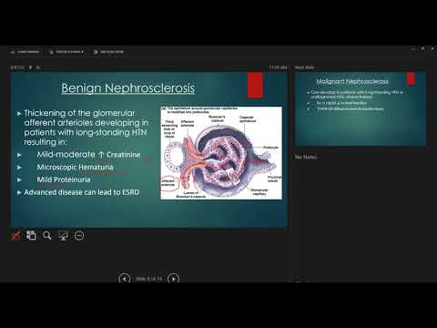 Renal, acute and chronic disease plus RCC and Thrombosis