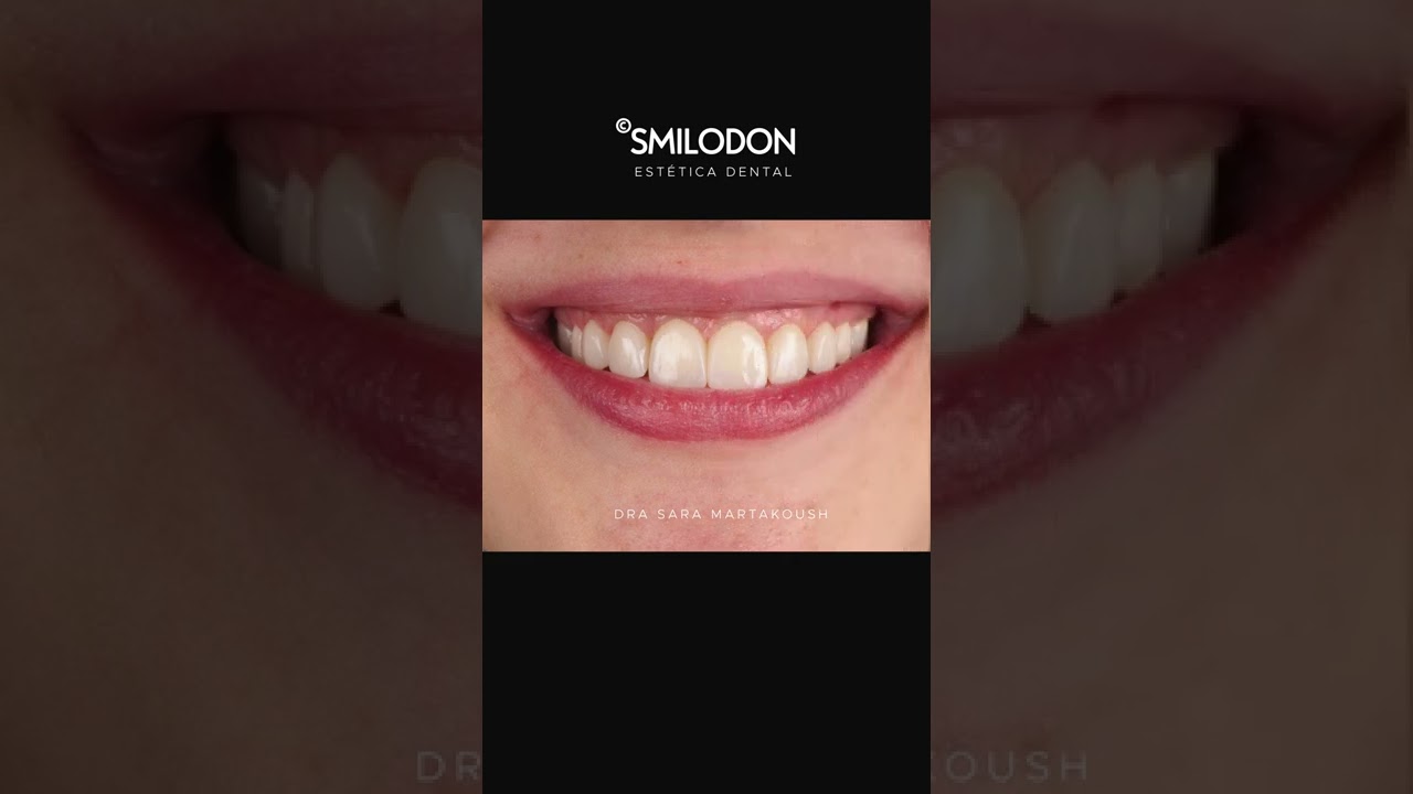 #Carillas dentales para mejorar #agenesia · Antes y después