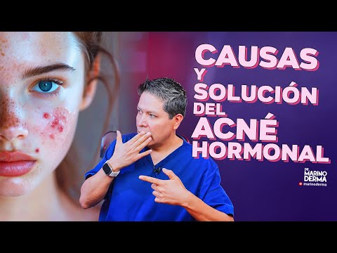 CAUSAS Y SOLUCIÓN DEL ACNÉ HORMONAL