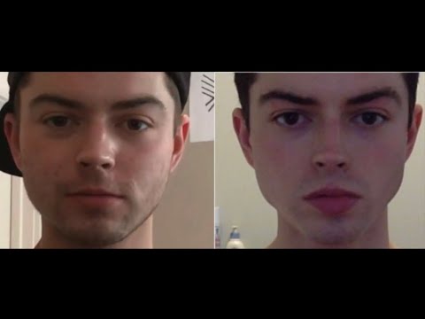 Does Mewing Actually Work?