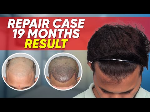 Hair Transplant in Turkey | Best Results & Cost of...