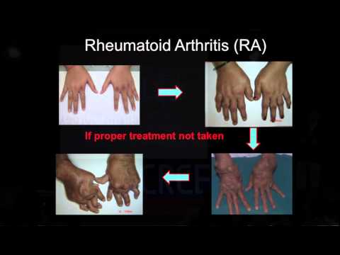 a deformáló artrózis konzervatív kezelése
