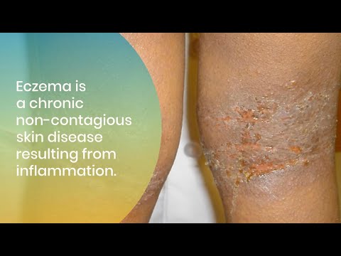 Treating and Managing Eczema in All Skin of Colors