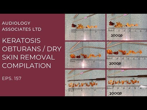 KERATOSIS OBTURANS/DRY SKIN REMOVAL COMPILATION - EP 157