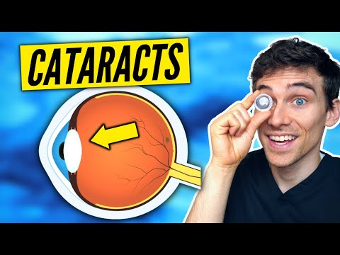 Cataracts Explained Simply - Symptoms, Causes, Treatments