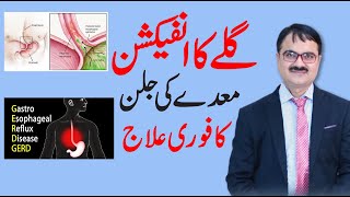 GERD Symptoms and Treatment - Throat Infection & GERD - Dr Tarique Ali Shaikh