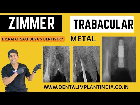 Trabecular metal implant by Zimmer  | Immediate dental implant surgery | Delhi Dentist