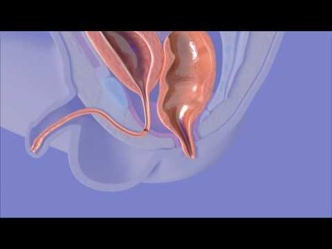 Anorectal Malformation Surgery