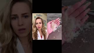 Doctor Reacts: Shaving HUGE foot callus!