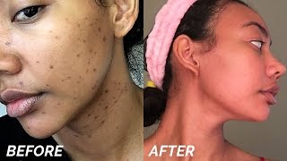 HOW TO GET RID OF DARK SPOTS & HYPERPIGMENTATION FAST!!