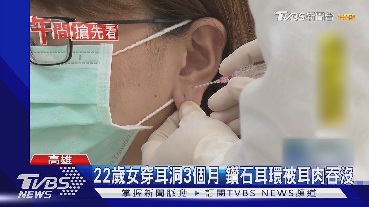 22歲女穿耳洞3個月 鑽石耳環被耳肉吞沒