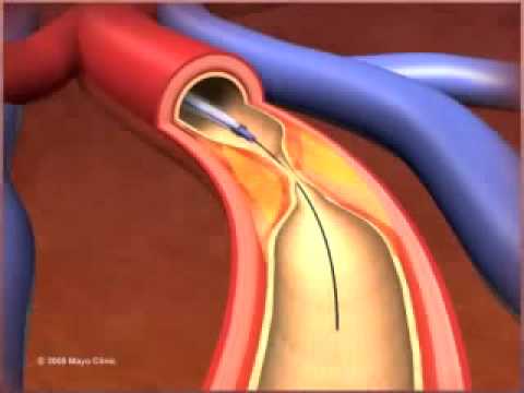 Percutaneous coronary Intervention stenting