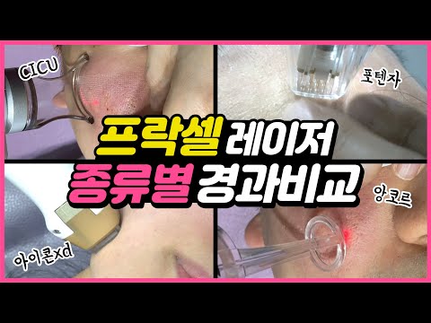 프락셀 레이저 후 딱지는 얼마나 남을까? 실제 프렉셔널 레이저 별 시술 후 경과 공개!