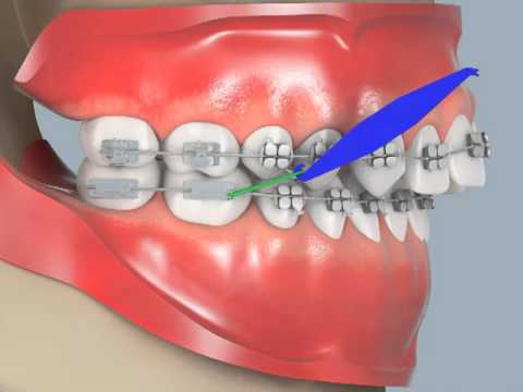 How to put on Class II Elastics