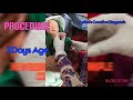 DMLT Online Class Newborn Baby Sample Collection Neonatal Venous Blood Collection Part II