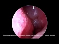 Nasal polyps on endoscopic examination