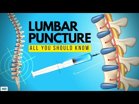 Lumbar Puncture:  Everything You Need to Know