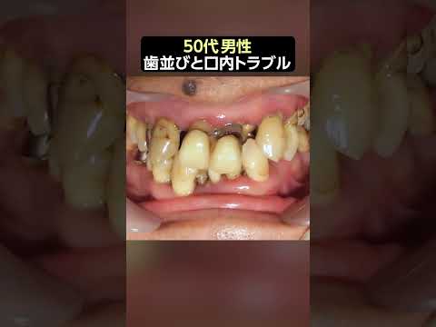 歯並びを治すことは口内の健康にも繋がります‼️ 【歯石除去】#ザホワイトデンタルクリニック  #歯医者 #仮歯  #歯石除去