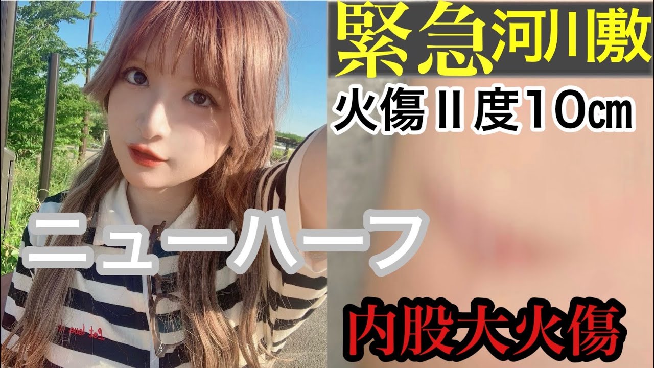 【悲報】太もも大火傷、重なった地獄3連発オワタ。緊急河川敷アラサー女。【めいチャンネル】