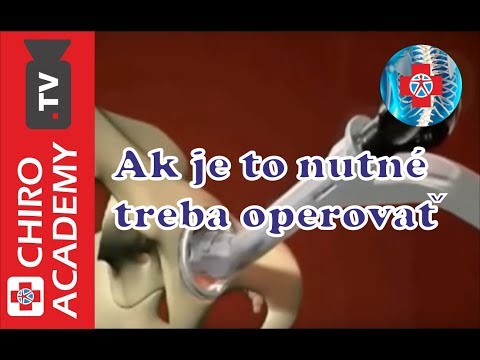Výmena bedrového kĺbu: Totálna endoprotéza a rehabilitácia po operácii