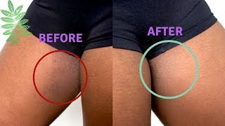 Clear Inner Thighs Fast | DIY