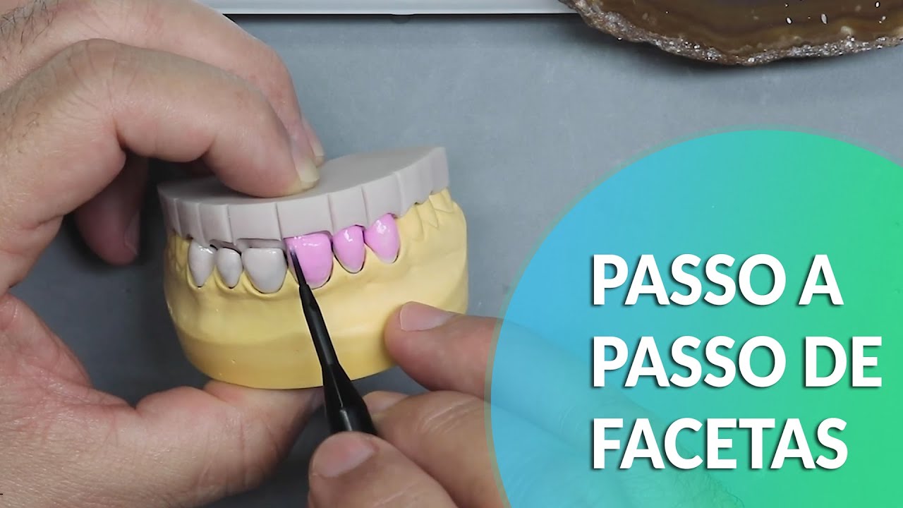 FACETS STEP BY STEP