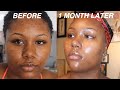 I FADED MY ACNE SCARS + GOT CLEAR SKIN DOING THIS FOR 1 MONTH! VIDEO PROOF | SKINCARE ROUTINE