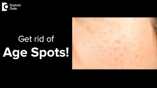 What are age spots? Can you get rid of age spots? - Dr. Urmila Nischal