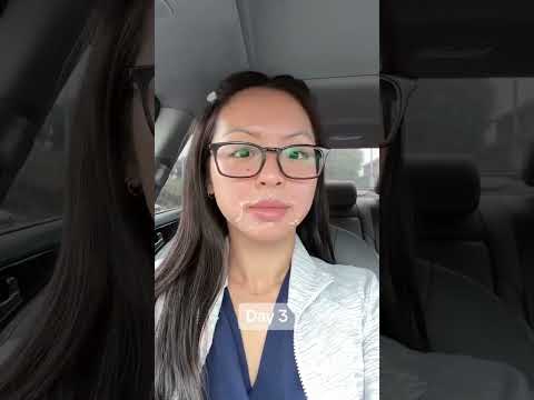 🌟 Get That Glow! Chemical Peel Before And After