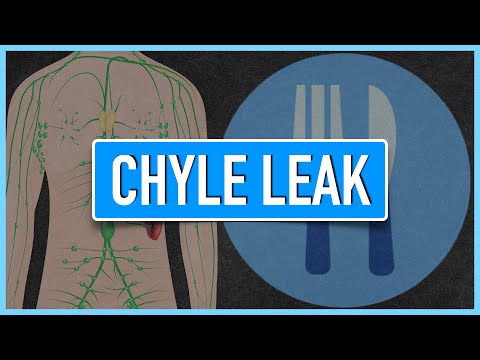 Chyle Leak | Emphasis on Diet/Nutrition
