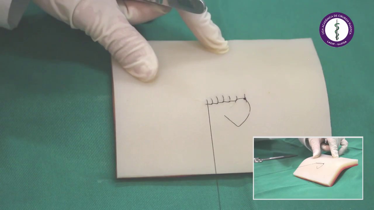 Sutura Festonada, Retrógrada, Ancorada de Ford ou de Reverdin
