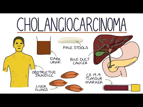 Primary Sclerosing Cholangitis Visual Explanation for Students