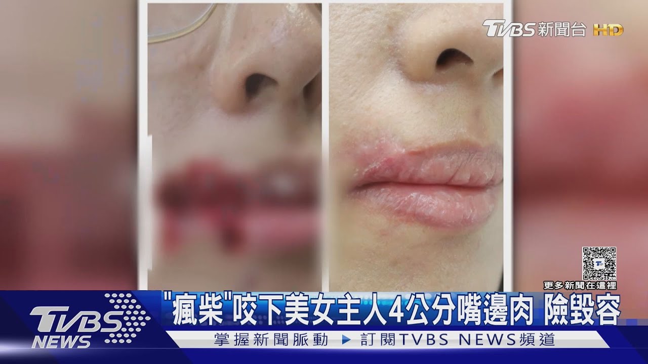 愛犬突翻臉!28歲女臉被咬掉4公分肉 「瘋柴」秒變暴君險毀容