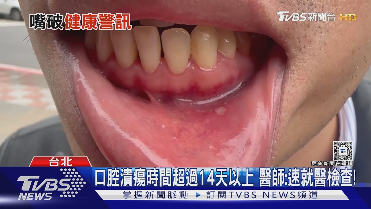 口腔反覆嘴破超過「這時間」 醫師:提高警覺速就醫