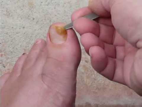 Ang pinakamahusay na lunas para sa mga paa halamang-singaw sa kanyang mga paa Paggamot ng fungal kuko sa paa Lotseril