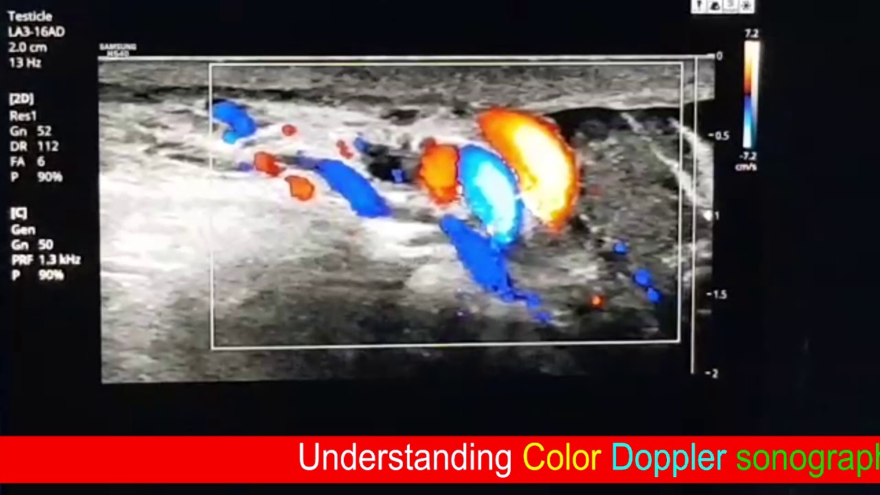 Scrotal Doppler ; Left Varicocele Tips of reflux diagnosis