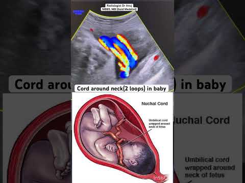 Cord around neck in baby#pregnancy #pregnancycare #ultrasound #radiologist #radiology #doctor