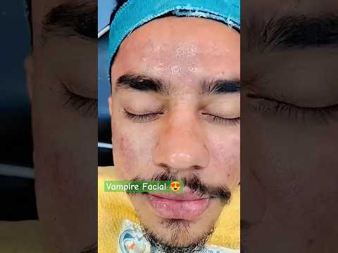 PRP Facial